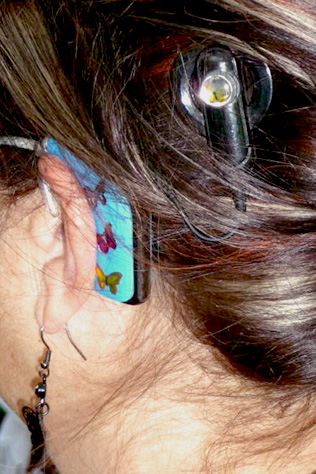 Die äußerlich sichtbaren Teile des CI: Sprachprozessor, Magnetspule Hinterkopfansicht, Haare, Ohr mit CI