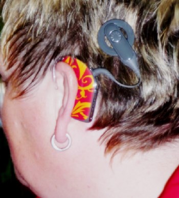 Auch ein CI kann als "Schmuck" getragen werden Kopf-Seitenansicht vom Ohr mit CI-Sprachprozessor
